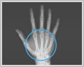手の骨のレントゲン図